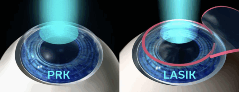What Is The True Difference Between PRK And LASIK?